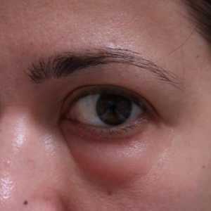 Cauzele și tratamentul ochii umflati
