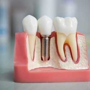 Cauzele și tratamentul edemelor după implantarea dinților