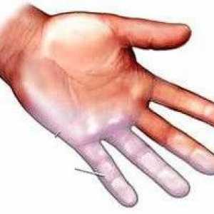 Cauzele amorțeală a degetelor și a tratamentului