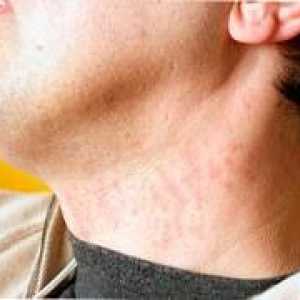 Cauzele de acnee pe gât și metode eficiente de tratament
