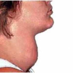 Cauze, simptome si tratamentul hipertiroidismului la femei