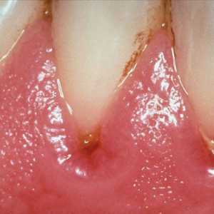 Cauzele si tratamentul abceselor guma