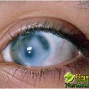 Simptomele și tratamentul glaucomului remedii populare