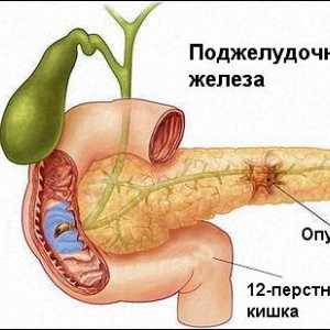 Caracteristicile și metodele de tratare a cancerului de pancreas
