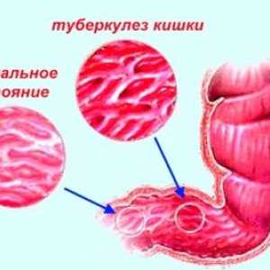 Simptomele tuberculozei intestinale