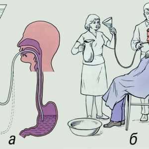 Procedura lavaj gastric sonda groasă