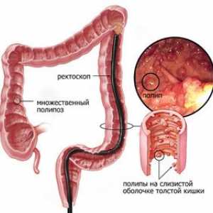 Simptomele și tratamentul de polipi in intestin