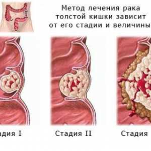 Tratamentul și prognosticul adenocarcinom de colon sigmoid