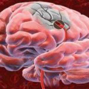 Prognoza și consecințele accident vascular cerebral ischemic