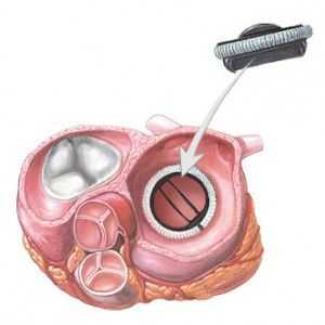 Valve cardiace prostetice: mitrala, aortica - operare, înainte și după