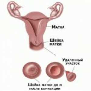 Realizarea procedurii de biopsie de col uterin