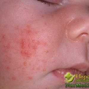 Remediu popular dovedita pentru acnee