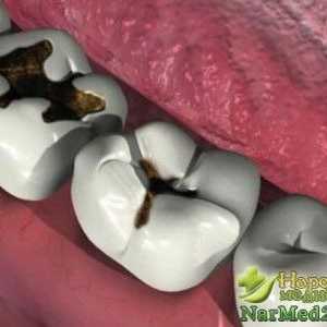 Dovedit vindecători populare sfaturi în tratamentul cariilor dentare