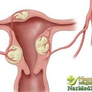 Lucrul remedii populare în tratamentul adenomioza uterin