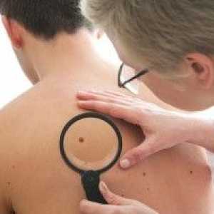Cancerul de piele: primele semne. Specii de variație.