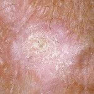 Cancer de piele
