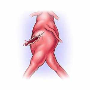 Ruptura aortica: cauze, simptome, cum să evite moartea, chirurgie, prognosticul