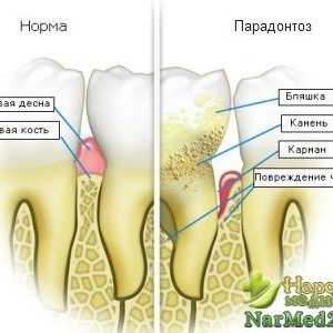 Rețete pentru a scăpa de boli parodontale pe baza remedii populare