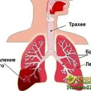 Riscul de pneumonie la adulți și copii