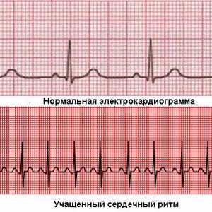 Heartbeat: prioritate ridicată și normală, cauze mai frecvente, cum și ce să trateze?