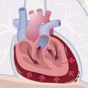 Tamponada cardiaca: simptome, diagnostic, prim ajutor, tratament