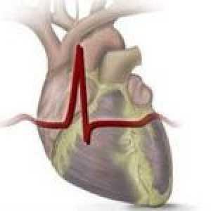 Cardiace reumatismale