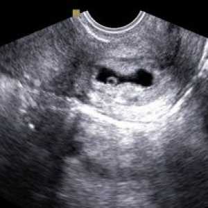 Sarcina de col uterin
