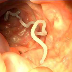 Simptomatologia și tratamentul de viermi
