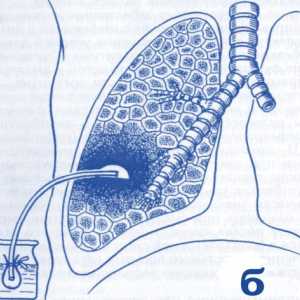 Simptomatologia și tratamentul abces pulmonar
