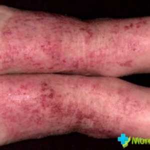 Simptomele dermatitei în fotografie. tipuri de dermatita