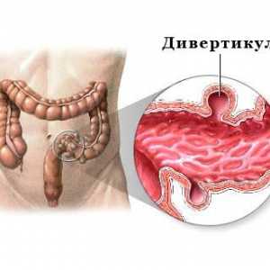 Rolul dietei in diverticuloza intestinului - prevenirea si tratamentul
