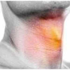 Simptomele și tratamentul hipertiroidie la bărbați