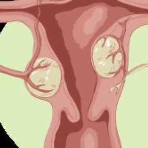 Simptomele si tratamentul fibrom uterin subseros interstițiale
