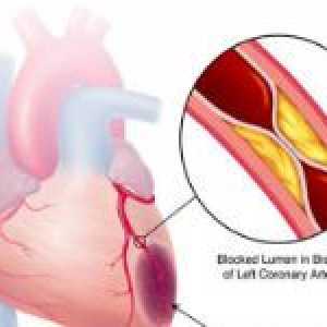 Simptomele și tratamentul ischemiei miocardice