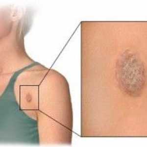 Simptomele și tratamentul lichenul roz