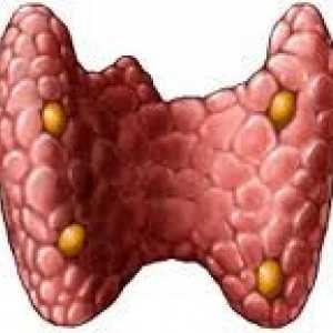 Simptomele și tratamentul noduli tiroidieni