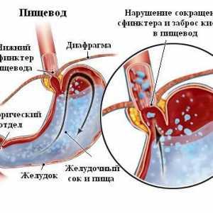 Cauzele si tratamentul disfagie esofagian