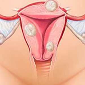 Simptomele de fibrom uterin în funcție de locație