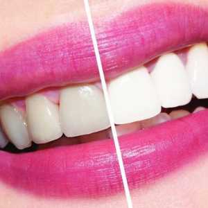 Cât de mult pentru albirea dinților în stomatologie?