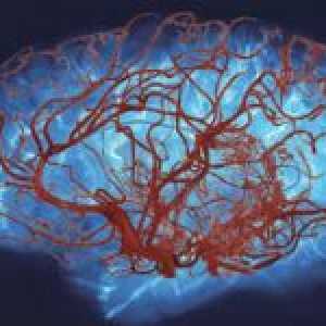 Boli vasculare ale creierului