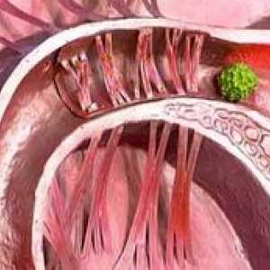 Aderențele în trompele uterine