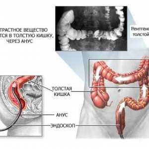 Aranjamentele pentru clisma intestinului bariu