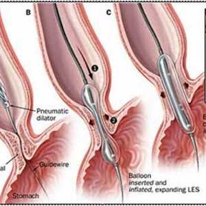 Metodele pentru tratarea akalazia esofagian