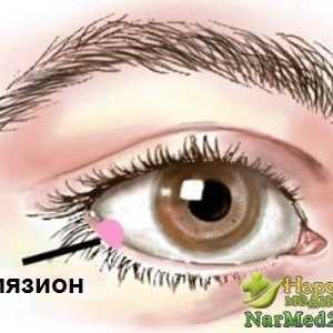Metode de tratare a unui ochi șalazion remedii populare