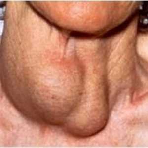 Metode de tratare a tiroidei gusa remedii populare multisite
