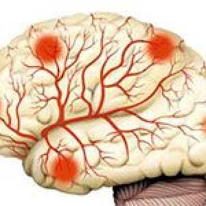 Ce instrumente sunt cele mai potrivite pentru consolidarea vaselor de sânge ale creierului?