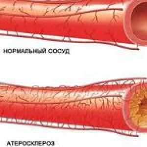 Ateroscleroza constrictiv