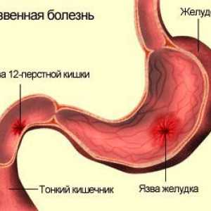 Structura, bolile și tratamentul ulcerului duodenal
