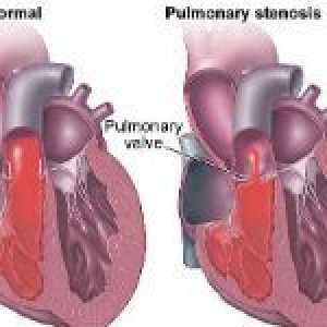 Îngustarea valvei pulmonare