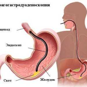 Procedură de stomac gastroscopie